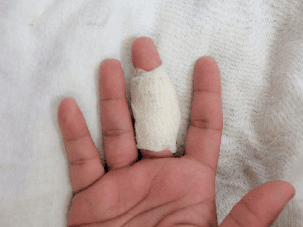 Perdi um dedo na máquina, isso me dá algum direito?